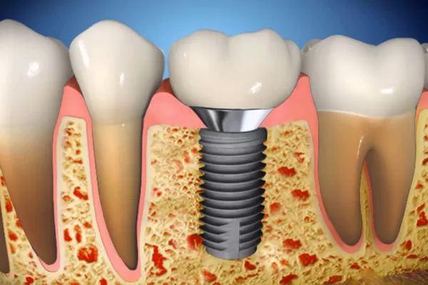 Зуб не плотно сидит в кости. Диаметр лунки больше, чем диаметр корня и зуб подвешен на связках